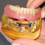 impla_6_2